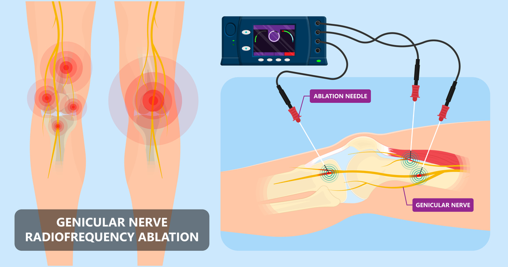 Radio Frequency Ablation
